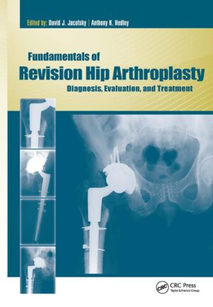 Fundamentals of Revision Hip Arthroplasty: Diagnosis, Evaluation, and Treatment