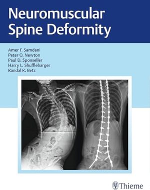 Neuromuscular Spine Deformity