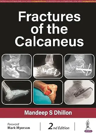Fractures of the Calcaneus, 2nd Edition (Original PDF from Publisher)