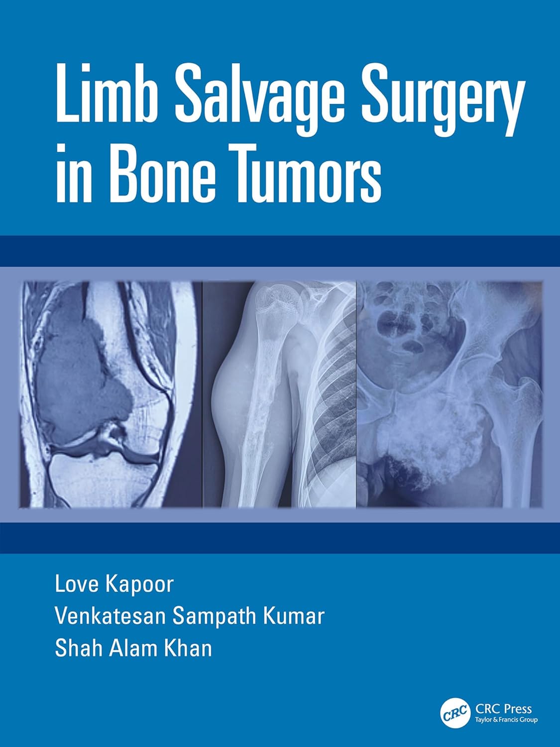 Limb Salvage Surgery in Bone Tumors (Original PDF from Publisher)